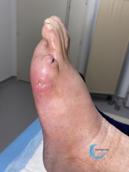 Fichier:Pied infecté45.jpg