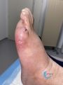 Pied infecté45.jpg