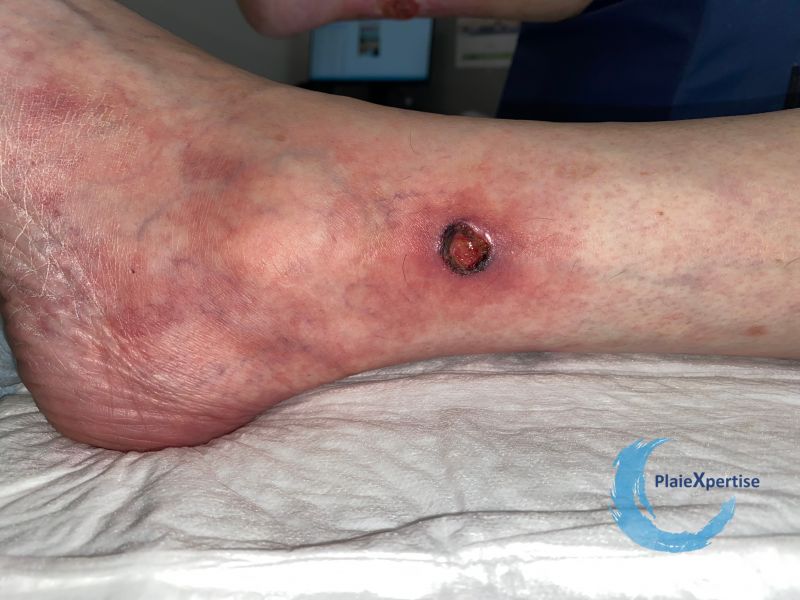 Fichier:Angiodermite typique99.jpg