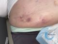 Calciphylaxie15.jpg