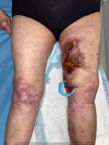 Fichier:Clciphylaxie 23.jpg