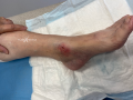 Pyoderma gangrenosum19.png