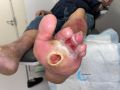 Pied infecté28.jpg