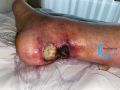 Tendon nécrotique humide57.jpg