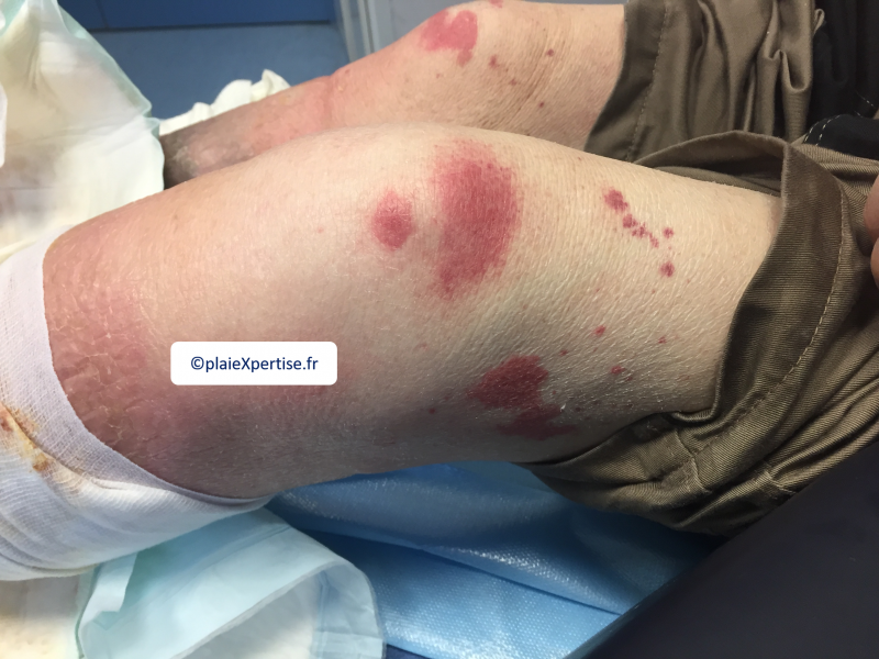 Fichier:Vascularite13.png