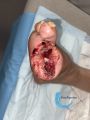 Amputation26.jpg