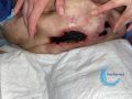Calciphylaxie12.jpg