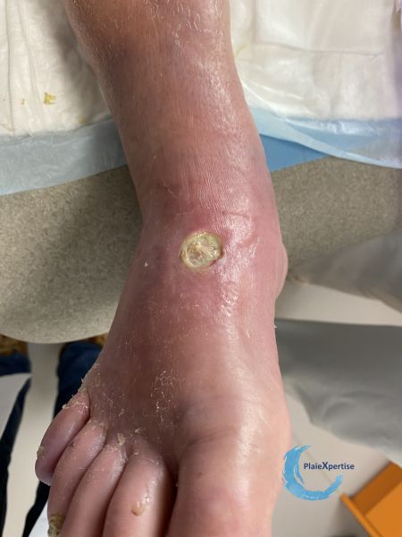 Fichier:Cou de pied77.jpg