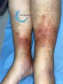 Hypodermite chronique58.jpg