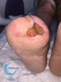 Amputation21.jpg