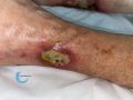 Angiodermite typique115.jpg