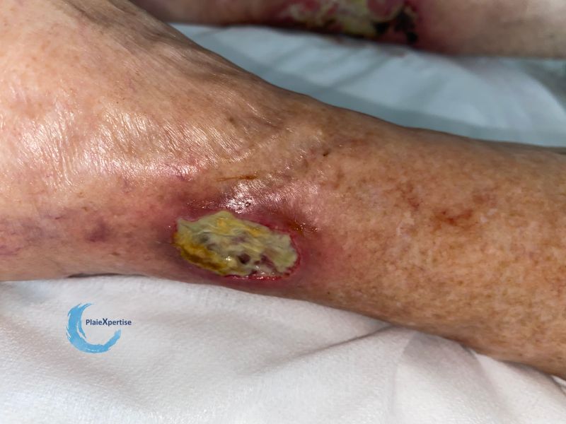 Fichier:Angiodermite typique115.jpg