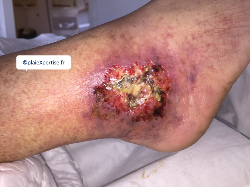 Fichier:Angiodermite typique14.png