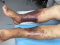 Dermiteocre91.jpg