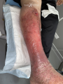 Eczéma68.png