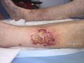 Pyoderma gangrenosum16.png