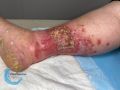 Pyoderma gangrenosum60.jpg