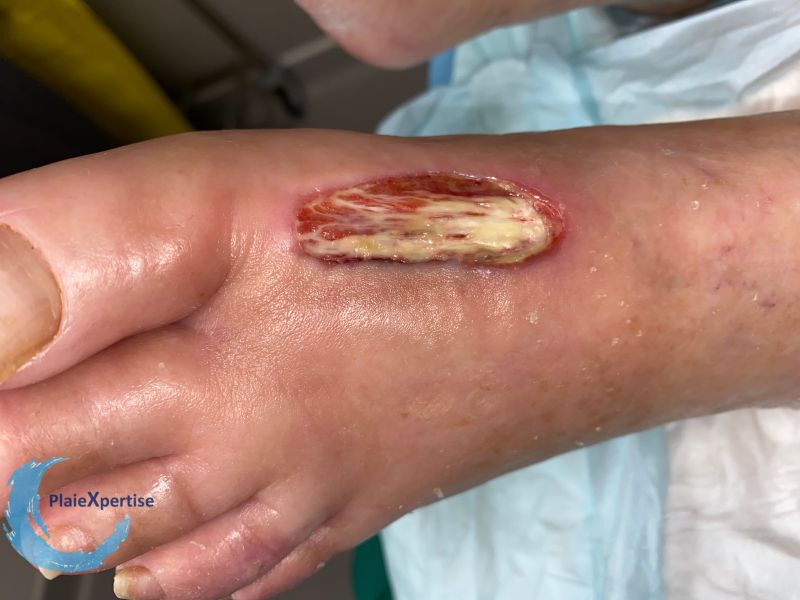 Fichier:Tendon normal40.jpg