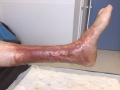 Dermite d'irritation19.jpg