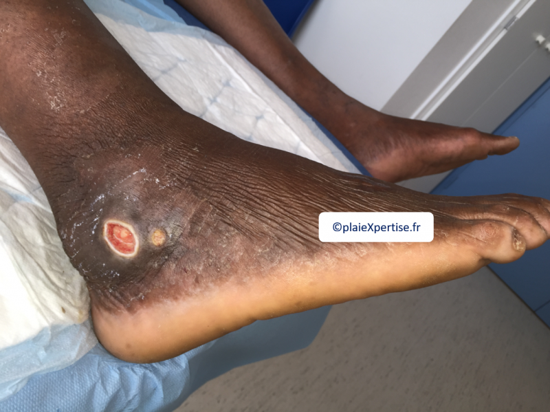 Fichier:Drépanocytose14.png