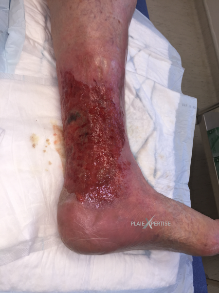 Fichier:Erosion en nappe41.png