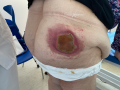 Nécrose par injection médicamenteuse1.png