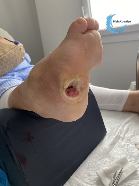 Fichier:Pied de Charcot34.jpg