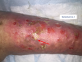 Pustules2.png