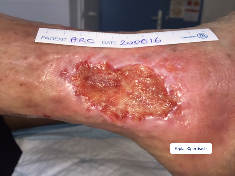 Fichier:Tissu de granulation scléreux2.png