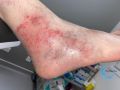 Dermite d'irritation100.jpg