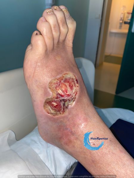 Fichier:Cou de pied111.jpg
