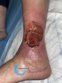 Tissu de granulation inflammatoire34.png