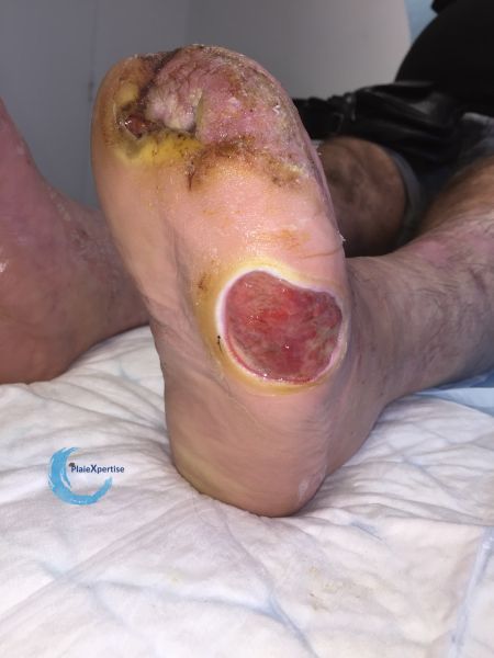 Fichier:Amputation TM1.jpg