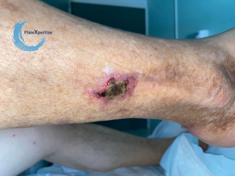 Fichier:Angiodermite typique67.jpg