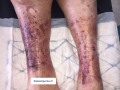 Purpura par fragilité capillaire2.png