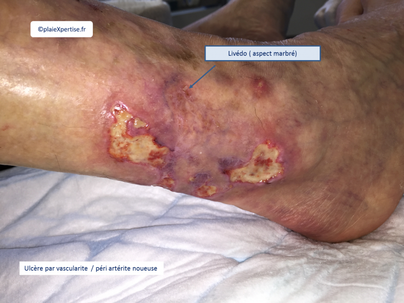 Fichier:Vascularite9.png