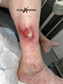 Angiodermite atypique13.png