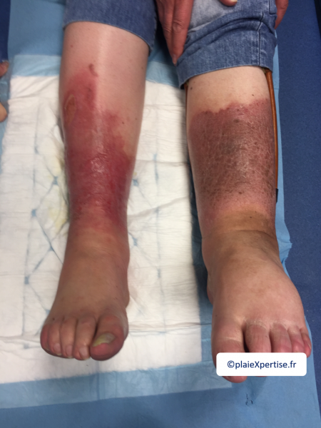 Fichier:Dermiteocre28.png