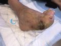 Pied de Charcot47.jpg