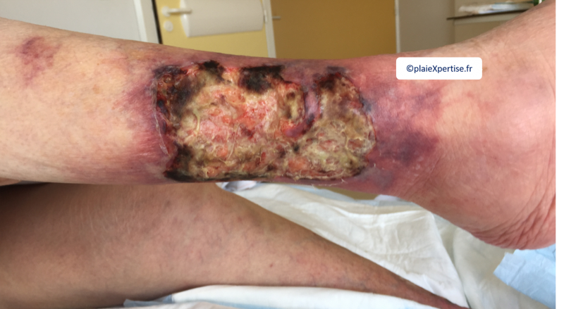 Fichier:Angiodermite typique2.png