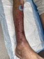 Dermite d'irritation110.jpg