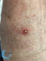 Pustules20.jpg