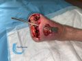Amputation57.jpg