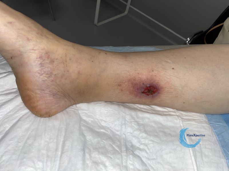 Fichier:Angiodermite typique109.jpg