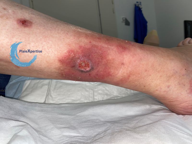 Fichier:Angiodermite typique68.jpg