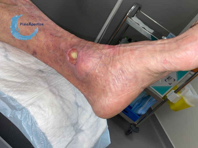 Fichier:Tendon normal34.jpg