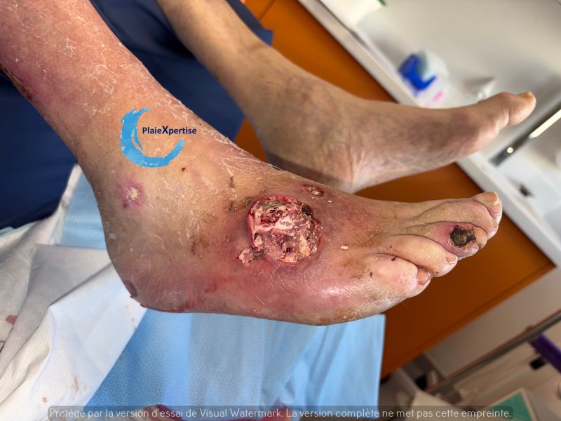 Fichier:Cou de pied110.jpg