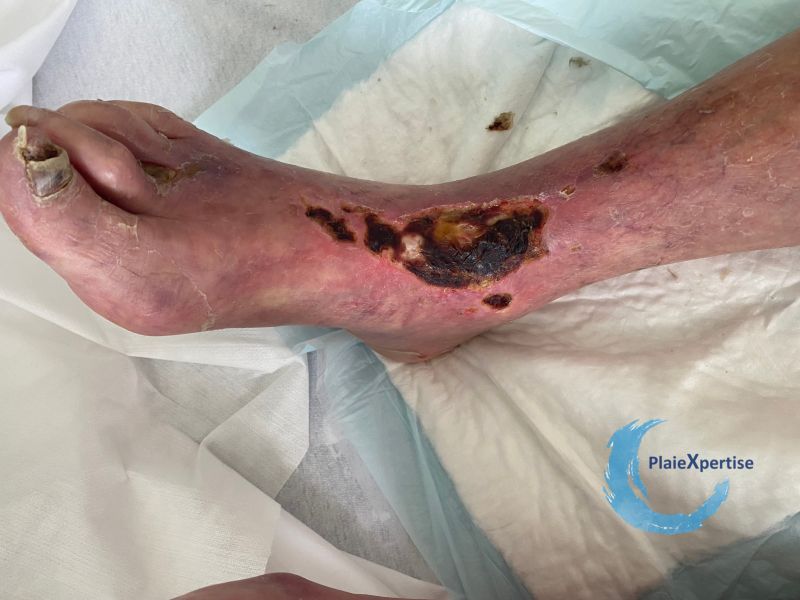 Fichier:Cou de pied74.jpg
