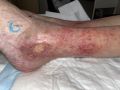 Dermite d'irritation141.jpg
