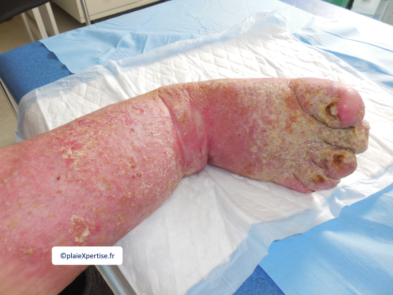 Fichier:Lymphoedème pied1.png